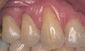 Fillings Gallery Case 10 Composite Bonding Fillings Gallery Case 10 Composite Bonding