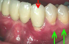 Periodontal Gallery - Soft Tissue Graft Case 2 Periodontal Gallery - Soft Tissue Graft Case 2