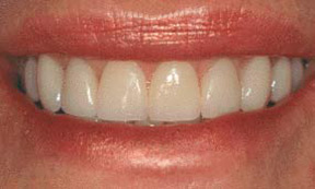 Porcelain Veneers Gallery Case 9 Porcelain Veneers Gallery Case 9
