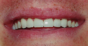 Porcelain Veneers Gallery Case 11 Porcelain Veneers Gallery Case 11